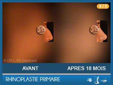 Rhinoplastie Primaire - First Rhinoplasty - Neuscorrectie