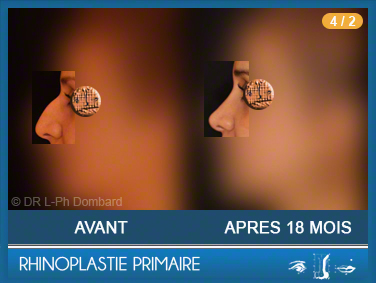 Rhinoplastie Primaire - First Rhinoplasty - Neuscorrectie