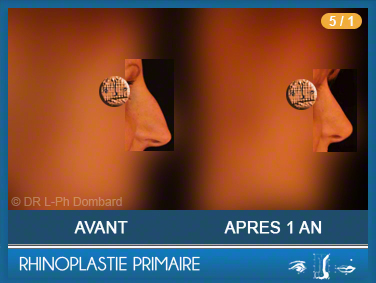 Rhinoplastie Primaire - First Rhinoplasty - Neuscorrectie