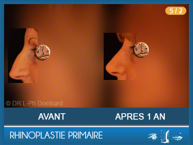 Rhinoplastie Primaire - First Rhinoplasty - Neuscorrectie