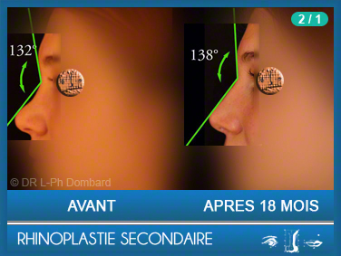 Rhinoplastie Secondaire - Rhinoplastie ratée - Rhinoplasty - Neuscorrectie