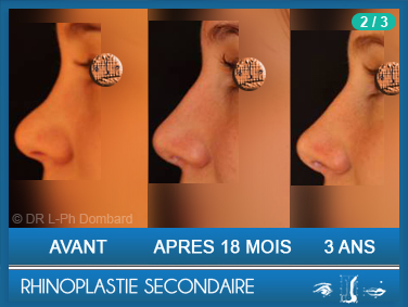 Rhinoplastie Secondaire - Rhinoplastie ratée - Rhinoplasty - Neuscorrectie