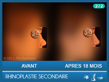 Rhinoplastie Secondaire - Rhinoplastie ratée - Rhinoplasty - Neuscorrectie