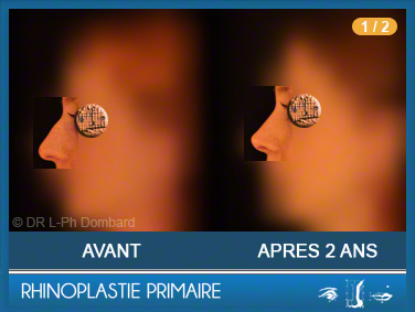 Première chirurgie du nez Primaire - First Rhinoplasty - Neuscorrectie