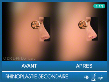 Rhinoplastie Secondaire - Rhinoplastie ratée - Rhinoplasty - Neuscorrectie