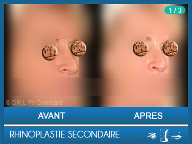 Rhinoplastie Secondaire - Rhinoplastie ratée - Rhinoplasty - Neuscorrectie