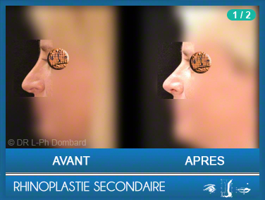 Rhinoplastie Secondaire - Rhinoplastie ratée - Rhinoplasty - Neuscorrectie