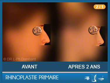 Première chirurgie du nez Primaire - First Rhinoplasty - Neuscorrectie