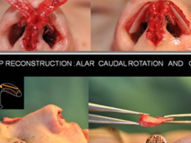 Rhinoplastie Primaire - Pendant l'opération: reconstruction de la pointe du nez