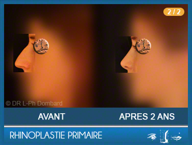Première chirurgie du nez Primaire - First Rhinoplasty - Neuscorrectie