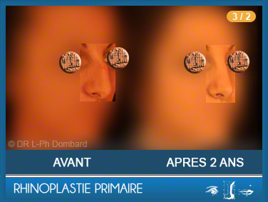 Première chirurgie du nez Primaire - First Rhinoplasty - Neuscorrectie