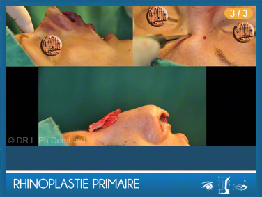 Rhinoplastie Primaire - First Rhinoplasty - Neuscorrectie
