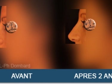 Rhinoplastie Primaire Avant Après 2 Ans