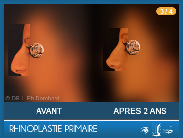 Rhinoplastie Primaire - First Rhinoplasty - Neuscorrectie