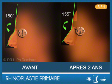 Première chirurgie du nez Primaire - First Rhinoplasty - Neuscorrectie