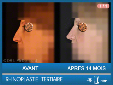 Rhinoplastie Tertiaire - Rhinoplastie ratée - Rhinoplasty - Neuscorrectie