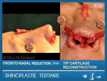 Rhinoplastie Tertiaire - Rhinoplastie ratée - Rhinoplasty - Neuscorrectie