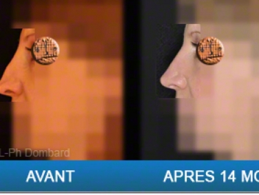 Rhinoplastie Tertiaire Avant Après 14 Mois