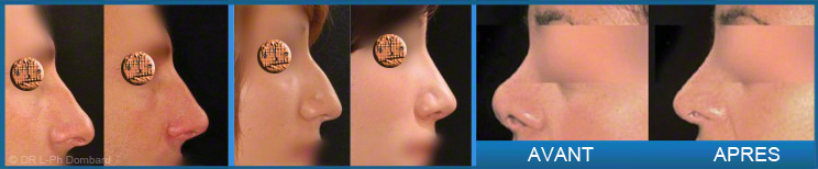 Rhinoplastie Prix Belgique - Neuscorrectie Prijs België