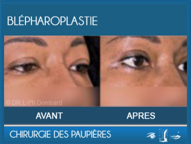 Chirurgie des paupières - Blépharoplastie