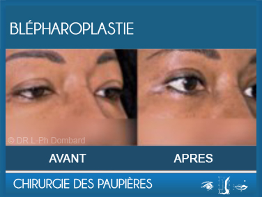 Chirurgie des paupières - Blépharoplastie