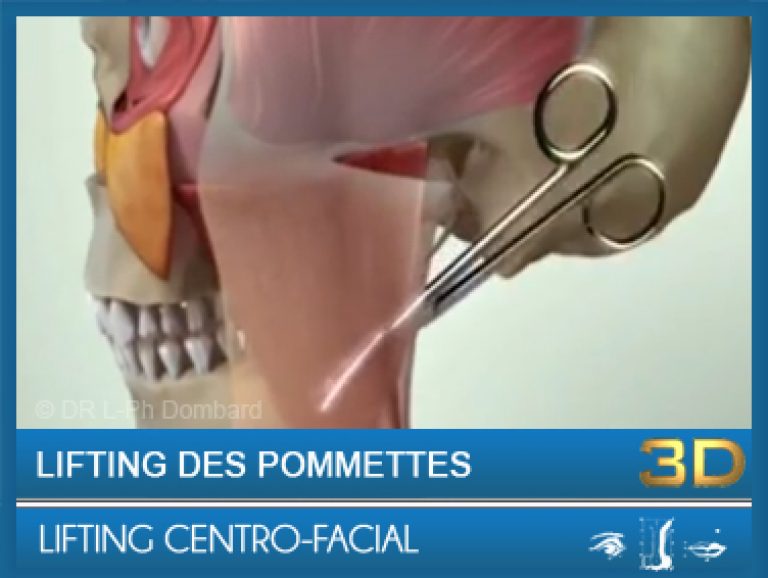 Lifting Centro-facial - Lifting des pommettes
