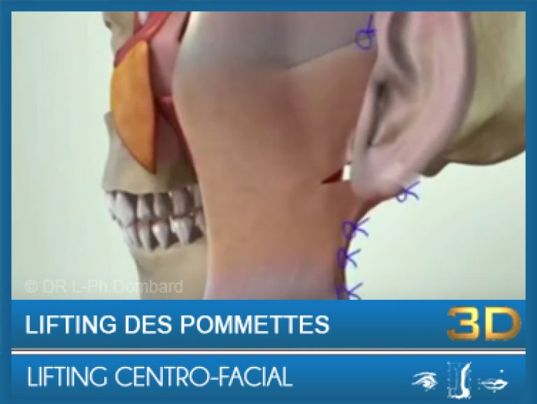 Lifting Centro-facial - Lifting des pommettes