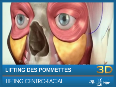 Lifting Centro-facial - Lifting des pommettes