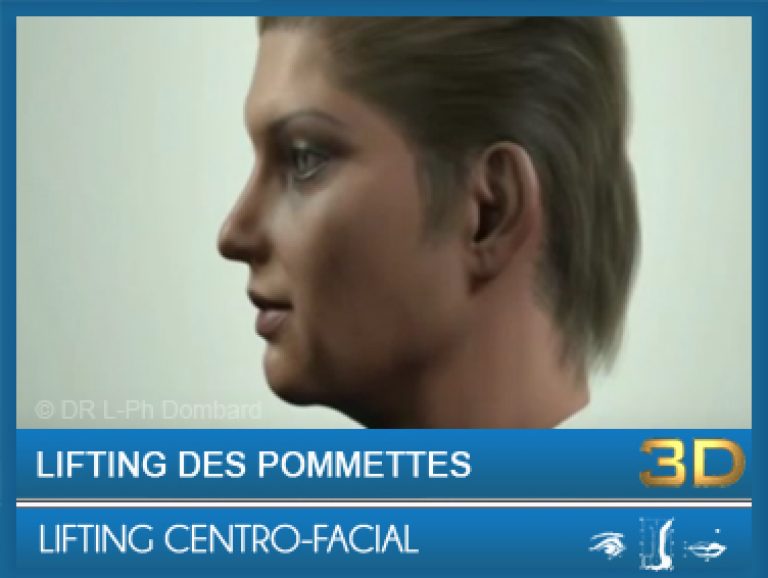 Lifting Centro-facial - Lifting des pommettes