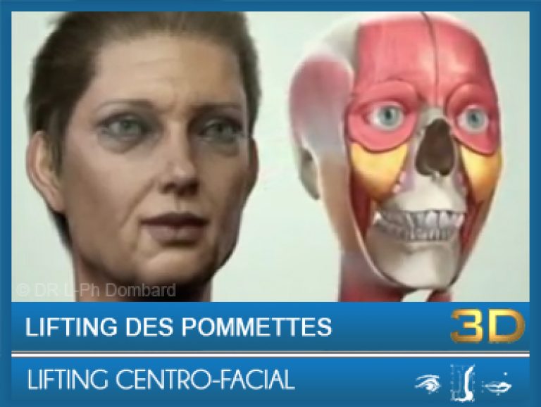 Lifting Centro-facial - Lifting des pommettes