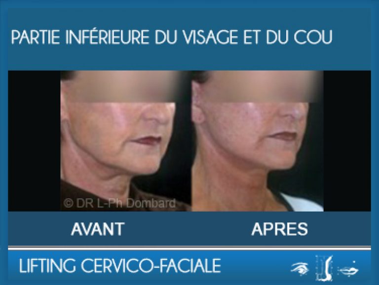 Lifting Cervico-Faciale: Partie inférieure du visage et du cou