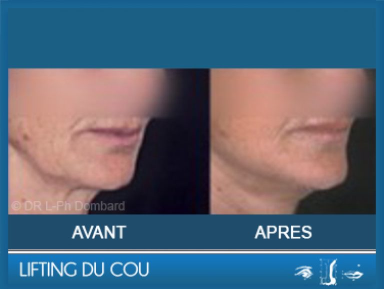 Lifting du cou