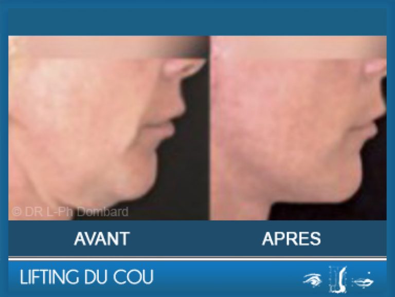 Lifting du cou