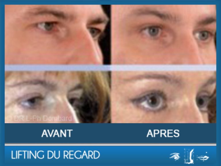 Lifting du regard