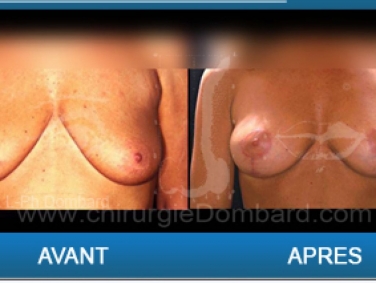 Ptoses mammaire, chirurgie des seins qui tombent.
