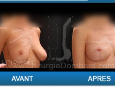 Ptoses mammaire, chirurgie des seins qui tombent.