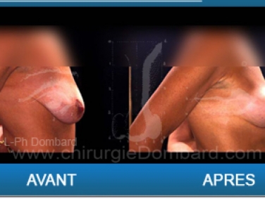 Ptoses mammaire, chirurgie des seins qui tombent.