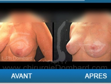 Ptoses mammaire, chirurgie des seins qui tombent.