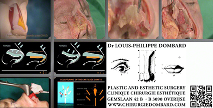Rhinoplastie Anatomie du nez - Haute Chirurgie Esthétique. DR L-Ph. Dombard.
