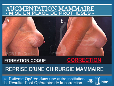 Augmentation mammaire