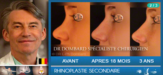 Rhinoplastie par DR Dombard, spécialiste chirurgien esthétique et plastique.