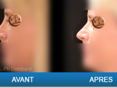 Chirurgie esthétique Rhinoplastie Secondaire par chirurgien spécialiste du nez
