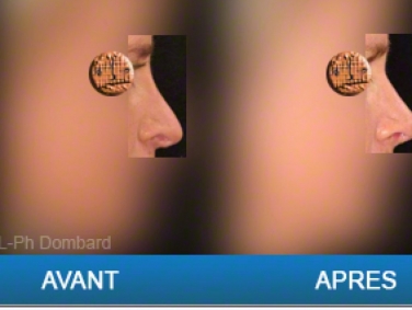 Chirurgie esthétique Rhinoplastie Secondaire par chirurgien spécialiste du nez