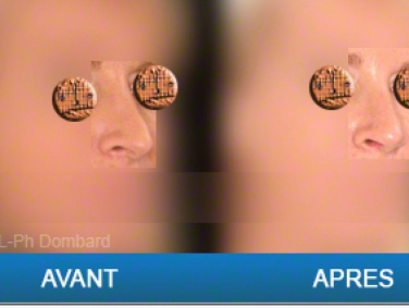 Chirurgie esthétique Rhinoplastie Secondaire par chirurgien spécialiste du nez