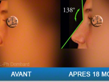Chirurgie esthétique Rhinoplastie Secondaire par chirurgien spécialiste du nez