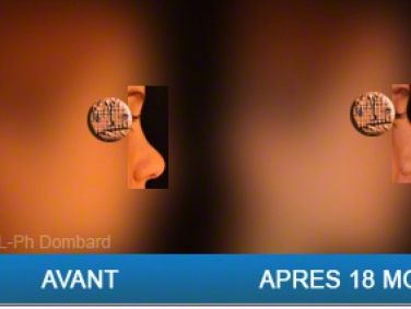 Chirurgie esthétique Rhinoplastie Secondaire par chirurgien spécialiste du nez