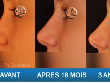 Chirurgie esthétique Rhinoplastie Secondaire par chirurgien spécialiste du nez