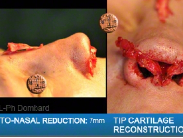 Chirurgie esthétique Rhinoplastie tertiaire. Reprise de chirurgie malmenée par spécialiste chirurgien du nez. Reconstruction du nez.