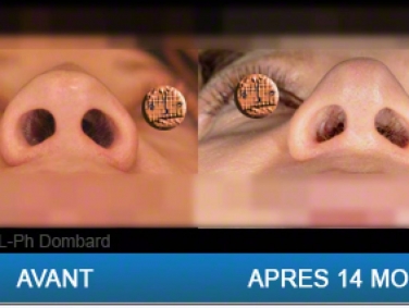 Chirurgie esthétique Rhinoplastie tertiaire. Reprise de chirurgie malmenée par spécialiste chirurgien du nez. Reconstruction du nez.