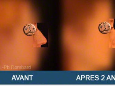 Chirurgie esthétique Rhinoplastie Primaire par spécialiste chirurgien du nez